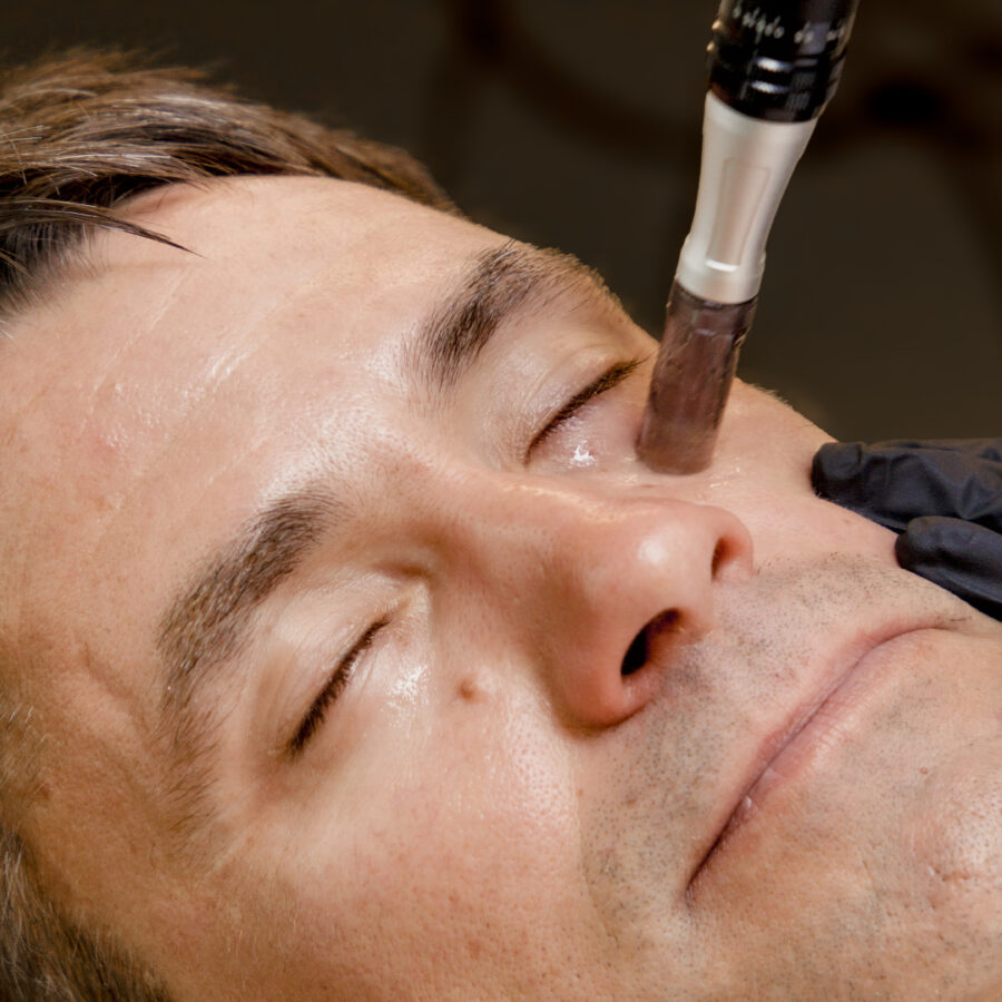 Microneedling ja ARES mesoteraapia